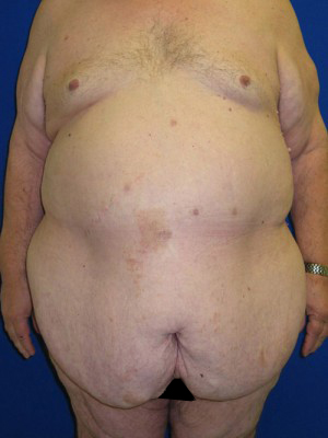 Panniculectomy Before And After Plastic Surgery Institute Of Washington