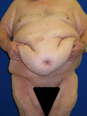 Panniculectomy Before And After Plastic Surgery Institute Of Washington