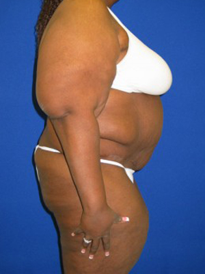 Panniculectomy Before And After Plastic Surgery Institute Of Washington