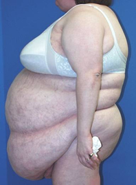 Panniculectomy Before And After Plastic Surgery Institute Of Washington