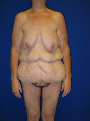 Panniculectomy Before And After Plastic Surgery Institute Of Washington