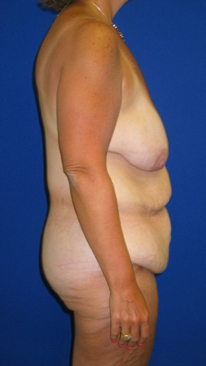 Panniculectomy Before And After Plastic Surgery Institute Of Washington