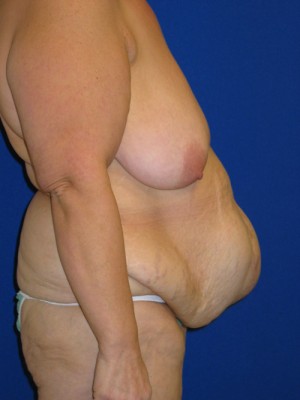 Panniculectomy Before And After Plastic Surgery Institute Of Washington