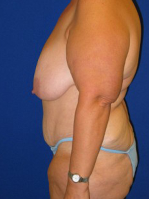 Panniculectomy Before And After Plastic Surgery Institute Of Washington