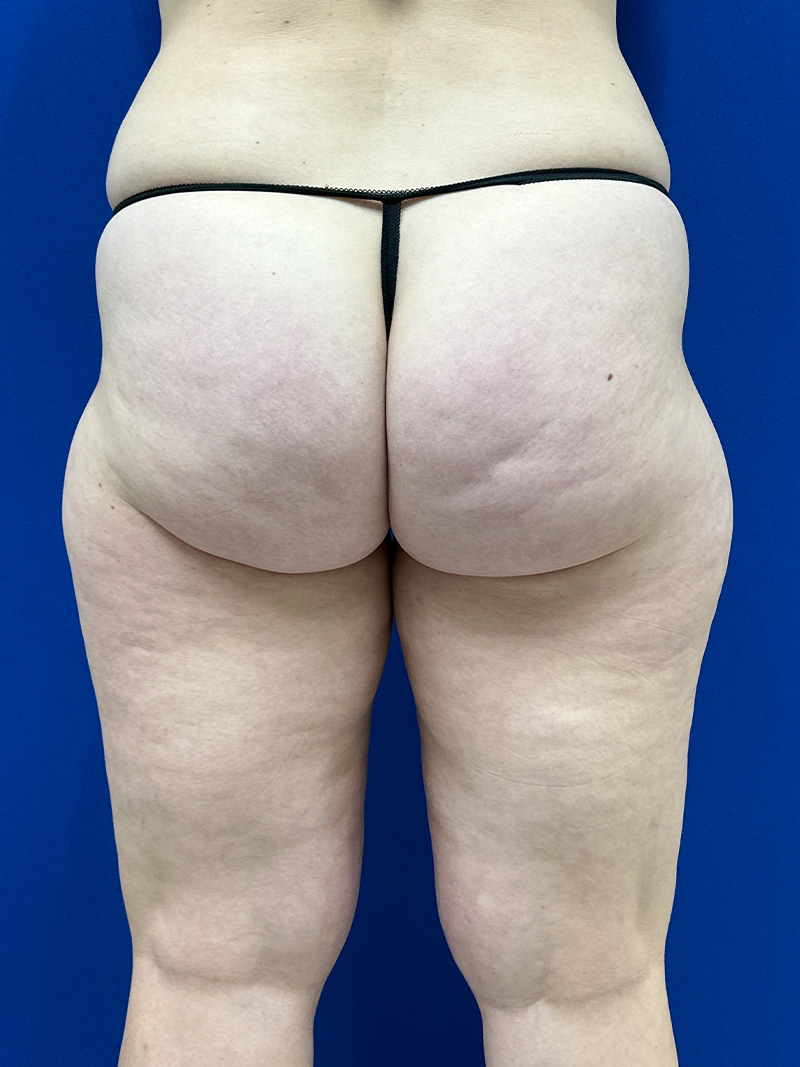 Aveli Cellulite Treatment Washington DC Before & After