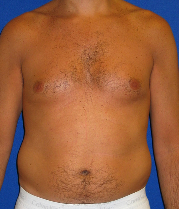 Case 354  Tummy Tuck Revision Before & After Photos