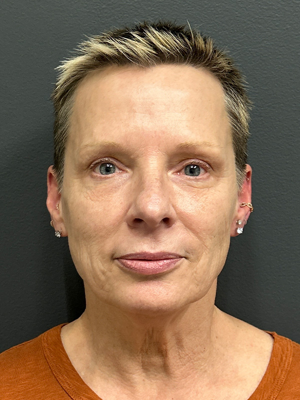 Dermal Fillers Washington DC