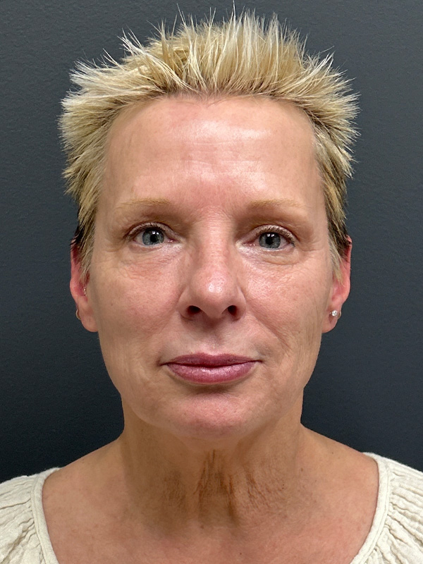 Dermal Fillers Washington DC